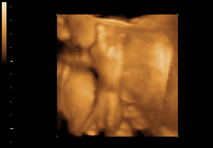 3D ultrasound image at 26 weeks